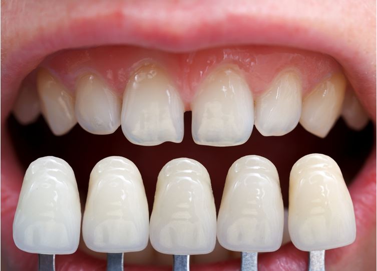 The Benefits Of Getting Porcelain Veneers 